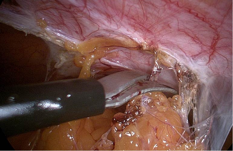 Adhesiolysis