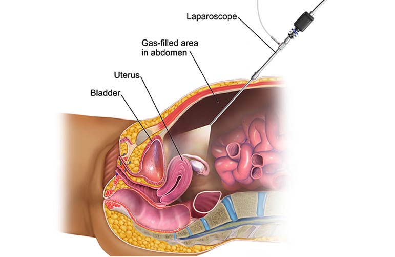 Diagnostic Laparoscopy