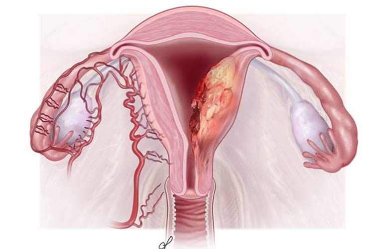 Endometrial Cancer