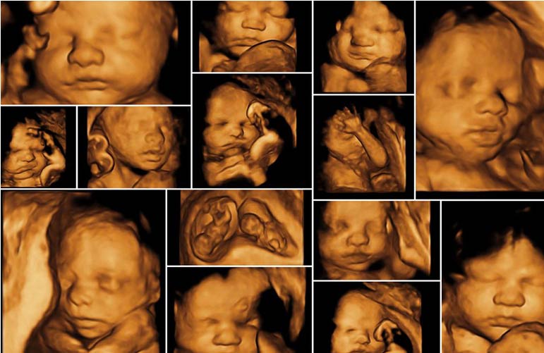 Gynec Sonography (3D and 4D)