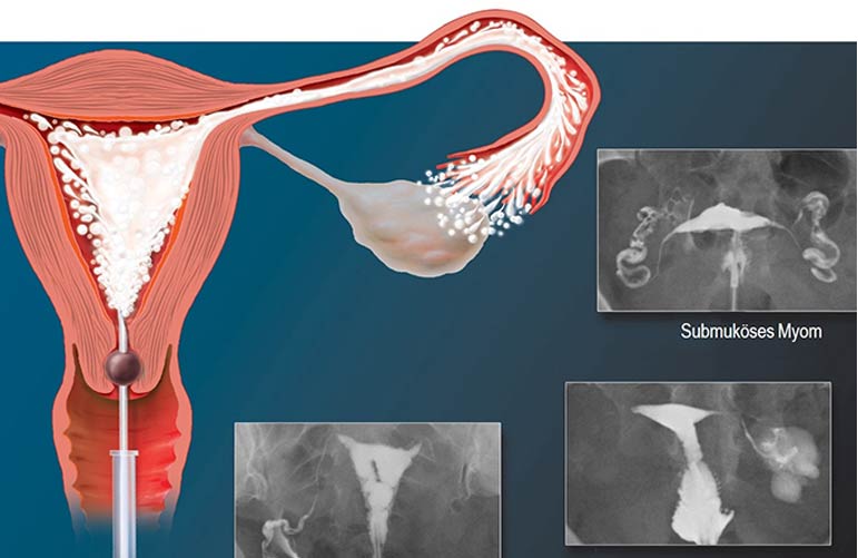 Hysterosalpingography (HSG)