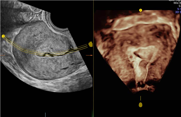 Infertility Sonography