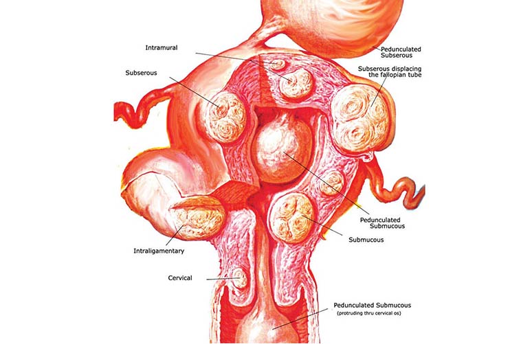 Myomectomy