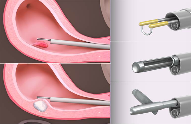 Operative Hysteroscopy