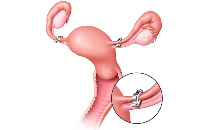 Ovarian And Tubal Surgery