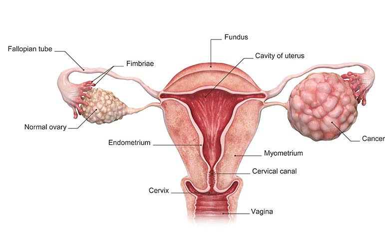 Ovarian Cancer