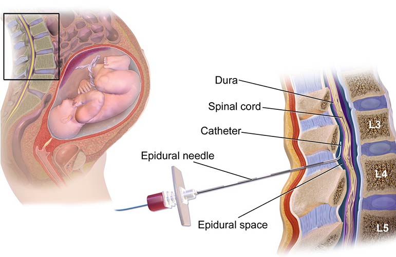 Painless Vaginal Delivery (Epidural)