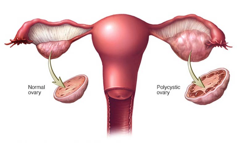 Polycystic Ovary Syndrome (PCOS)
