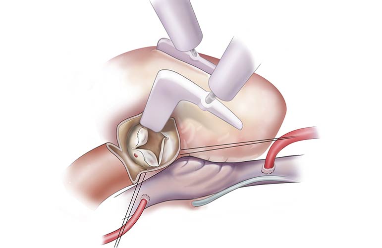 Septal Resection