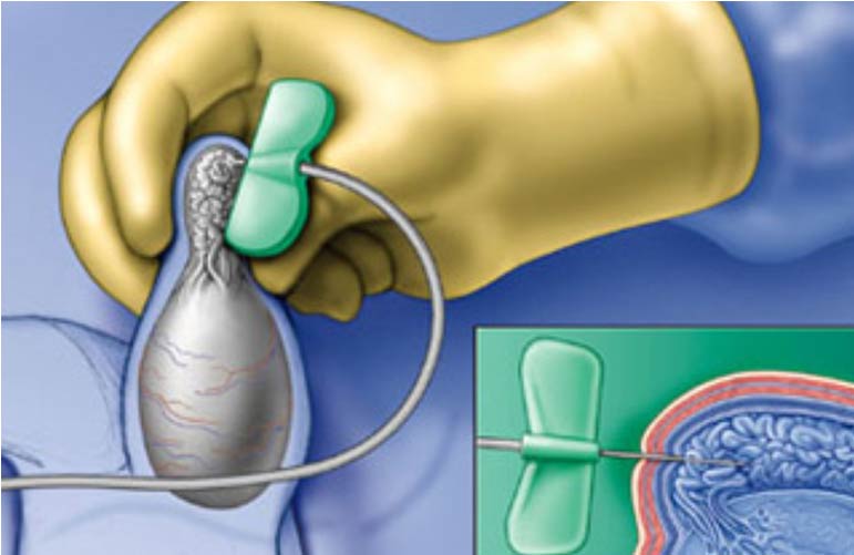 TESR/PESA (Surgical Sperm Retrieval)