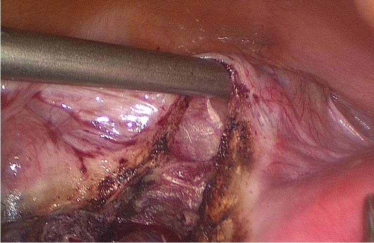 Total Laparoscopic Hysterectomy (TLH)