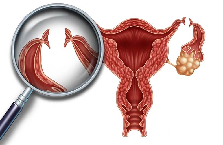 Tubal Ligation