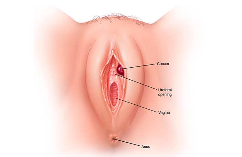 Vulvar Cancer
